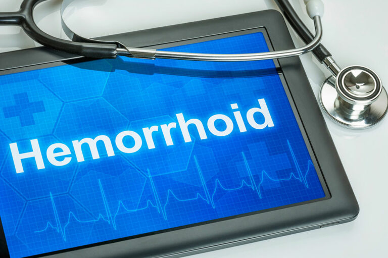 Best ways to manage hemorrhoids