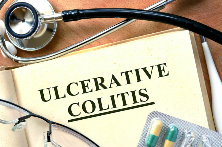 4 signs that indicate ulcerative colitis development