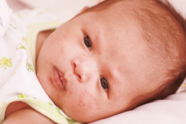 Atopic dermatitis in infants &#8211; Signs and management tips